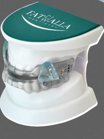 Mandibular Advancement Device (MAD) , Oral Appliance for obstructive sleep apnea treatment